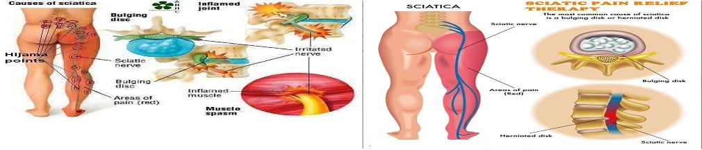 Hijama Bangladesh